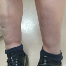 발목과 종아리 부위가 전반적으로 단단하게 부어 있는 다리의 모습으로, 순환 저하나 심장 기능 약화로 인해 나타날 수 있는 특징적인 다리 붓기 상태를 보여주는 이미지.