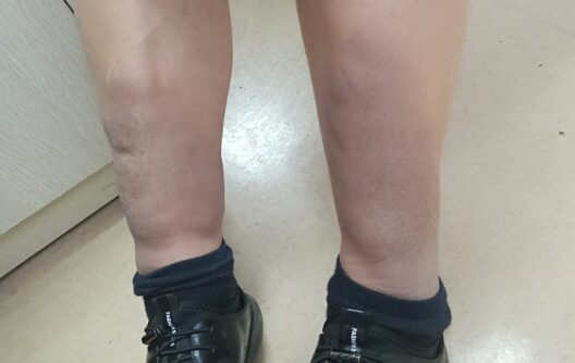 발목과 종아리 부위가 전반적으로 단단하게 부어 있는 다리의 모습으로, 순환 저하나 심장 기능 약화로 인해 나타날 수 있는 특징적인 다리 붓기 상태를 보여주는 이미지.