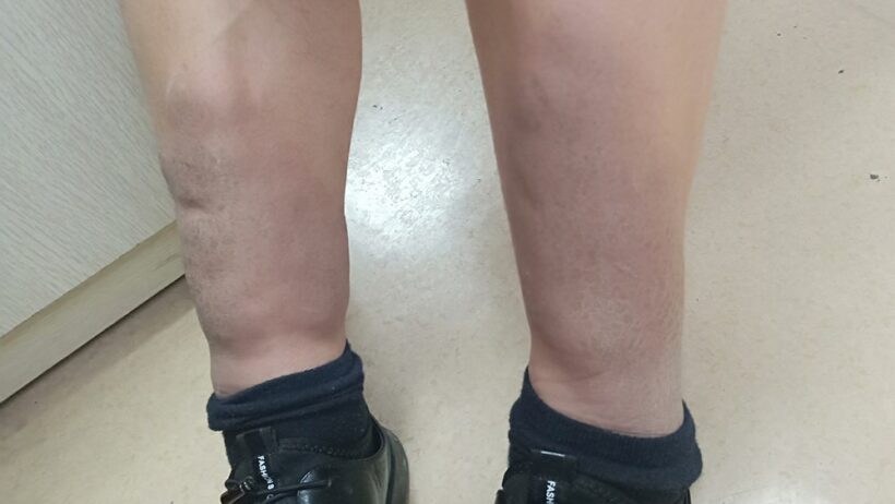 발목과 종아리 부위가 전반적으로 단단하게 부어 있는 다리의 모습으로, 순환 저하나 심장 기능 약화로 인해 나타날 수 있는 특징적인 다리 붓기 상태를 보여주는 이미지.