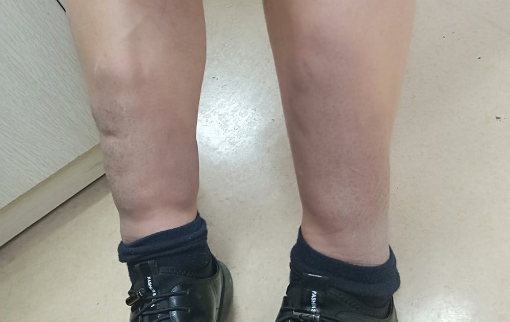 발목과 종아리 부위가 전반적으로 단단하게 부어 있는 다리의 모습으로, 순환 저하나 심장 기능 약화로 인해 나타날 수 있는 특징적인 다리 붓기 상태를 보여주는 이미지.