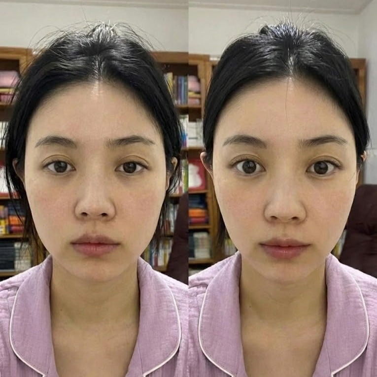 얼굴이 부어 보이는 상태와 비교 후 모습이 나란히 보이는 사진으로, 몸이 자꾸 부으면서 얼굴에도 나타나는 변화를 설명하는 이미지.